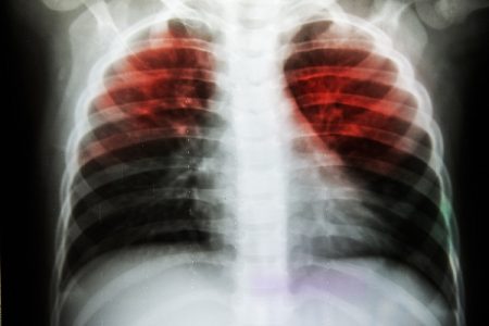 What Does Lung Cancer Look Like on an X-ray?