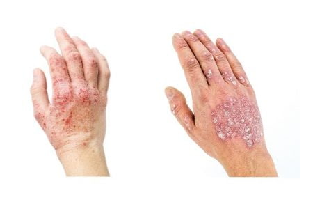 Psoriasis VS Eczema: What Is the Difference?