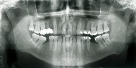 How to Read Dental X Rays or Radiographs for Cavities?