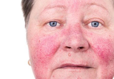What Are the Signs and Symptoms of Rosacea?