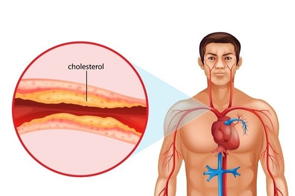 plaque-buildup-cause-of-coronary-heart-disease-diseasefix