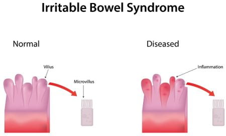 What You Should Know About Irritable Bowel Syndrome?