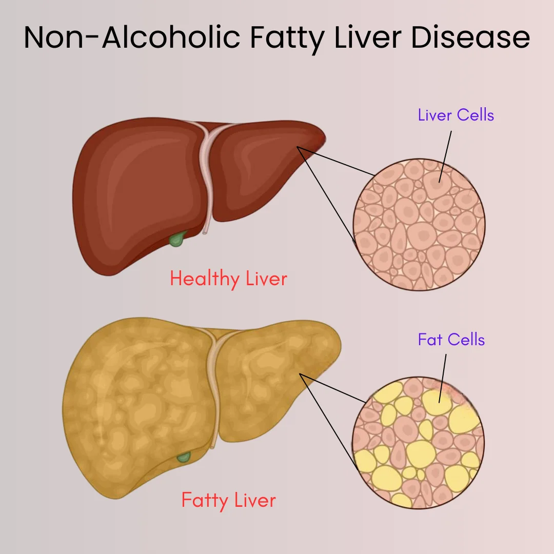 Non-Alcoholic Fatty Liver Disease