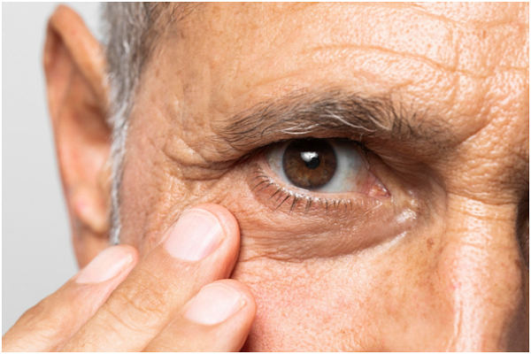 Caring for a Scratched Eye: 5 Tips to Relieve Corneal Abrasion
