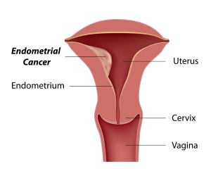 What is endometrial cancer?