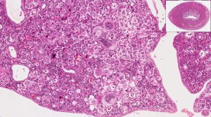 Microscopic view of endometrial cancer