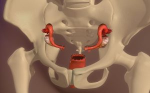 Hysterectomy 3d illustration