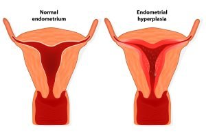 Normal endometrium vs endometrium in a woman with hyperplasia