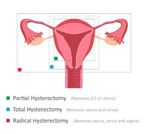 Types of Hysterectomy