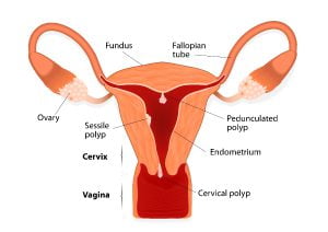 Uterine polyps