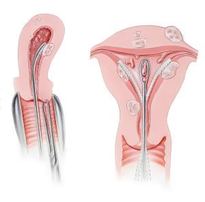 Uterus - Dilation and Curettage Procedure