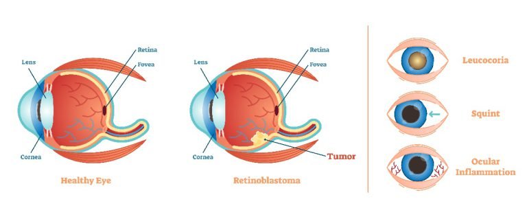 Retinoblastoma symptoms