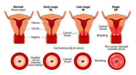Image of cervix