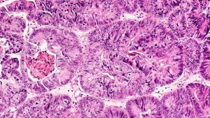 Photomicrograph of adenocarcinoma of endometrium in a biopsy