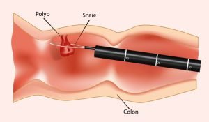 Image for polypectomy using colonoscopy