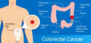 Colostomy, stoma, and colostomy Bag pictures