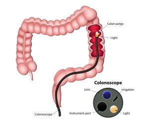 Colonscopy and colonscope image