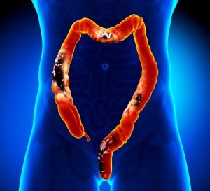 Colorectal cancer and polyps in the intestine