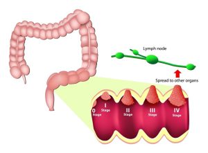 Stages of colorectal cancer