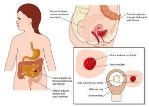 Colostomy in front and side view with detail of colostomy bag