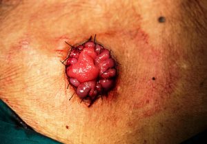 Colostomy surgery photograph in a patient