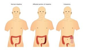 Surgery of intestine: colostomy, colostomy pouch