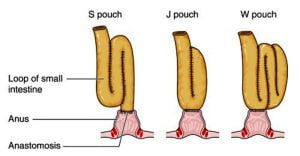 Colostomy pouch formation