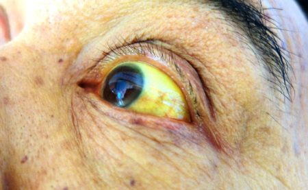 Jaundice is yellowing of the eyes and skin