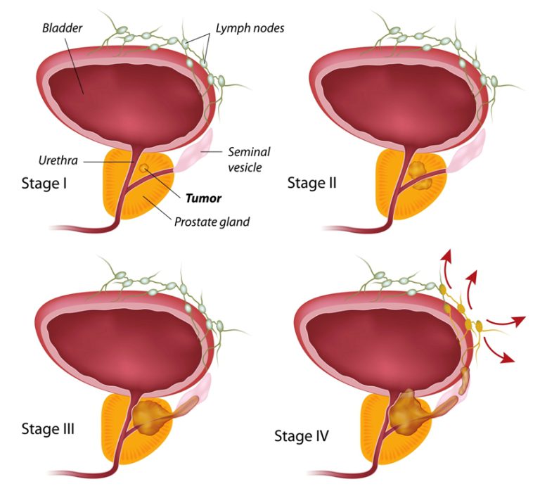 Stages of prostate cancer