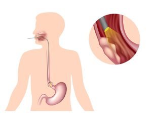 Location of primary esophageal cancer