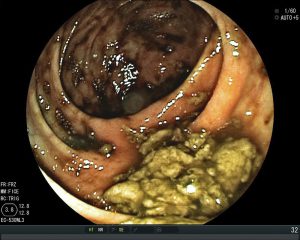 Upper gastrointestinal endoscopy