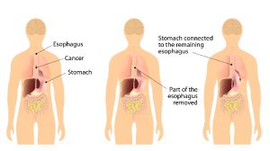 Surgery to remove esophageal cancer