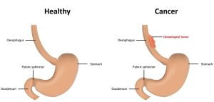 Healthy GI tract vs section with esophageal cancer/tumor