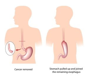 Esophageal cancer surgery image