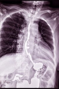 Esophageal cancer X ray photograph