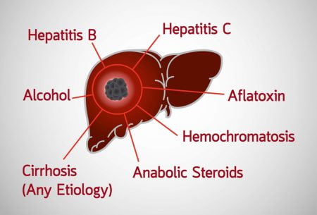Liver cancer risk factors