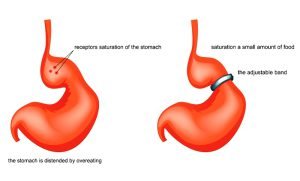 Can weight loss surgery cause esophageal cancer?