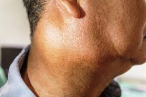 Signs and symptoms of salivary gland cancer