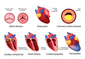 Heart diseases