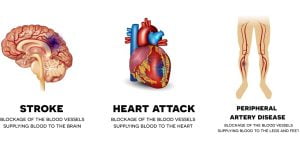 Diabetes and its chronic complications