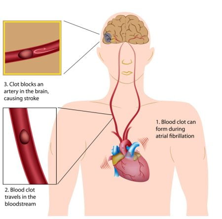 Blood clot can form during atrial fibrillation