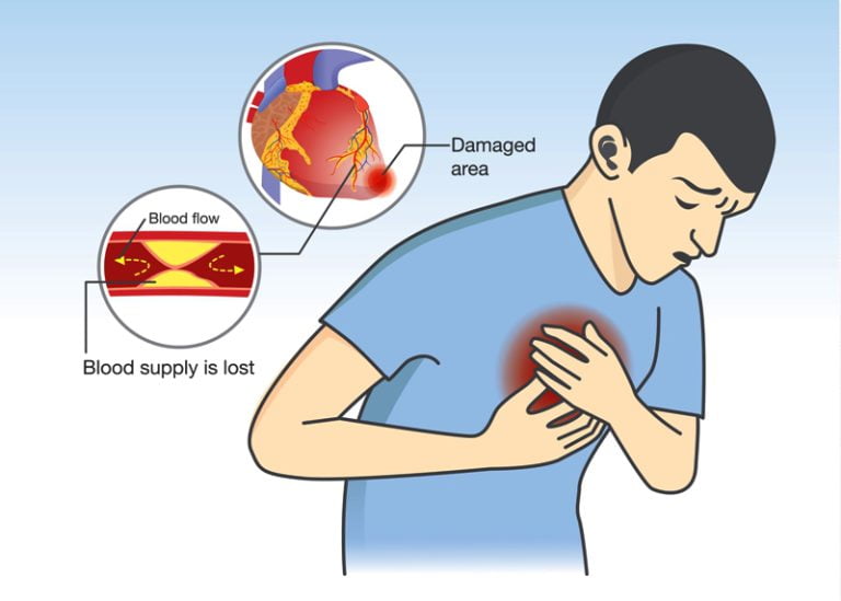 Adrenal Cancer and Adrenal Tumors