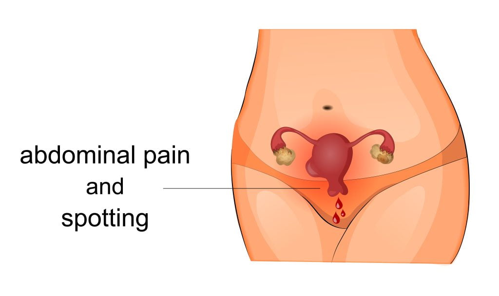 Abdominal pain and spotting