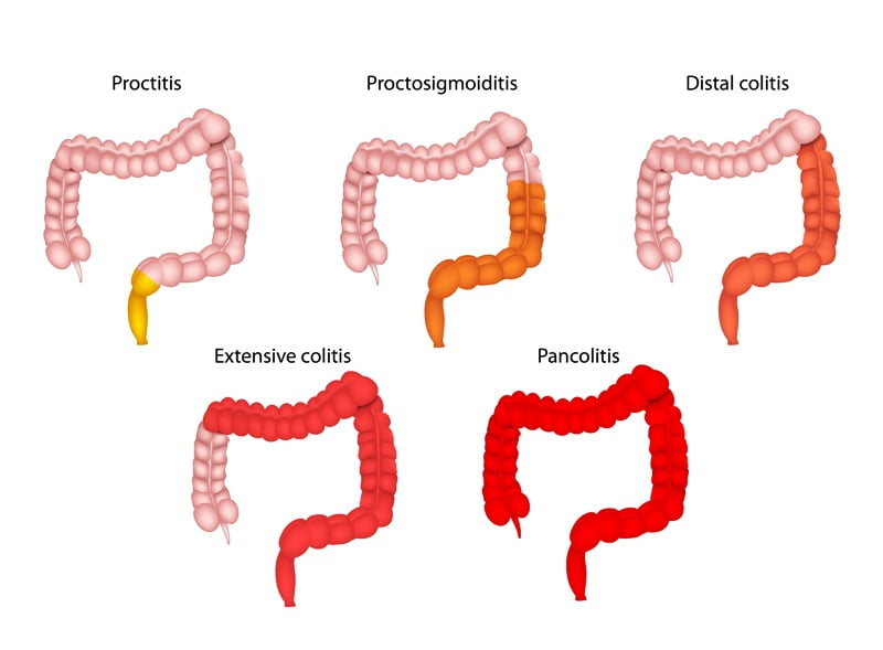 Circumcised Vs Uncircumcised Penis Circumcision Meaning Definition Boys Males Men Infection 6453