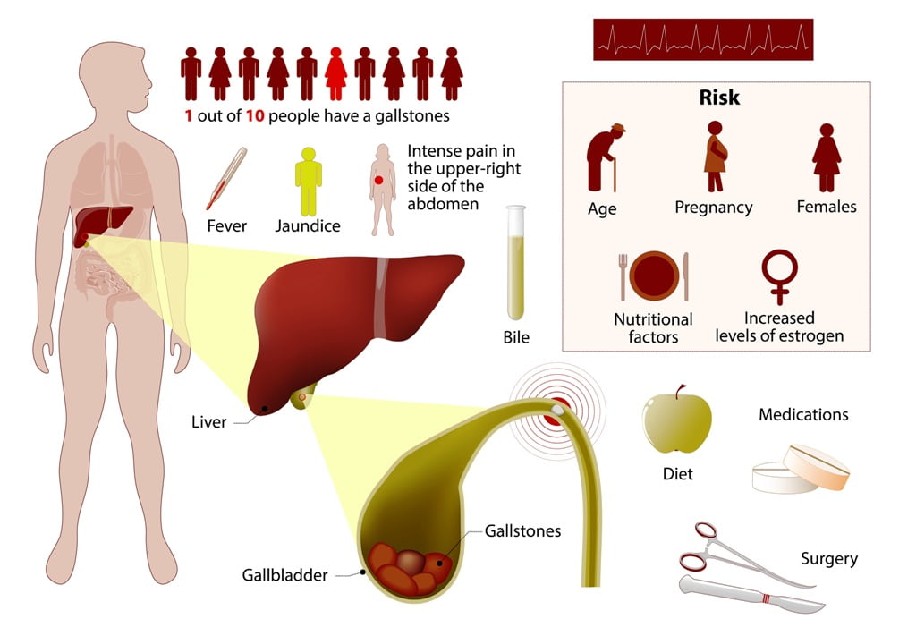 Risk of gallstones