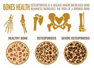 Osteoporosis stages image