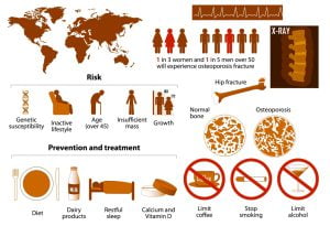 Risks, signs, symptoms, prevention, and treatment of osteoporosis