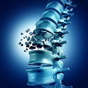 3D illustration of spinal fracture due to osteoporosis