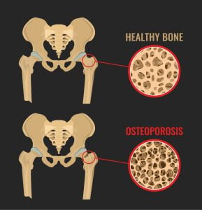 Osteoporosis of the hip