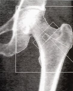 DEXA densitometry hip scan